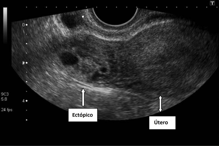 grossesse extra-utérine par ultrasons