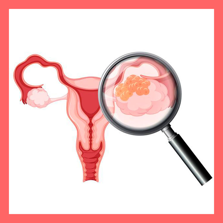 10 symptômes de cancer de l'ovaire qui pourraient passer inaperçus