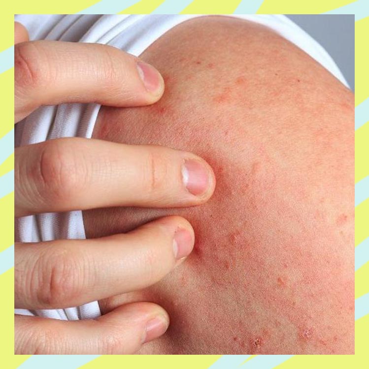 10 remèdes à la maison pour la dermatite atopique