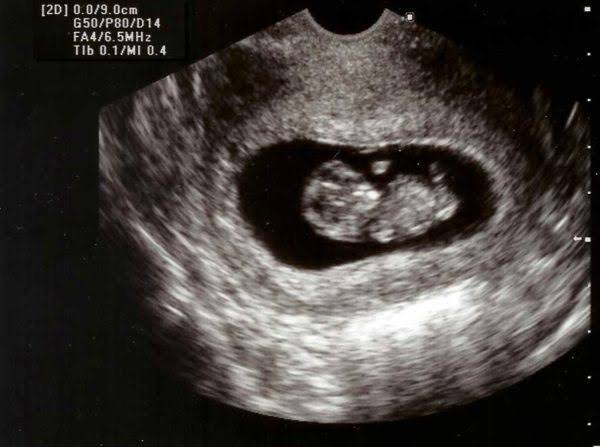 exstrophie-cloacale-grossesse-quatre semaines