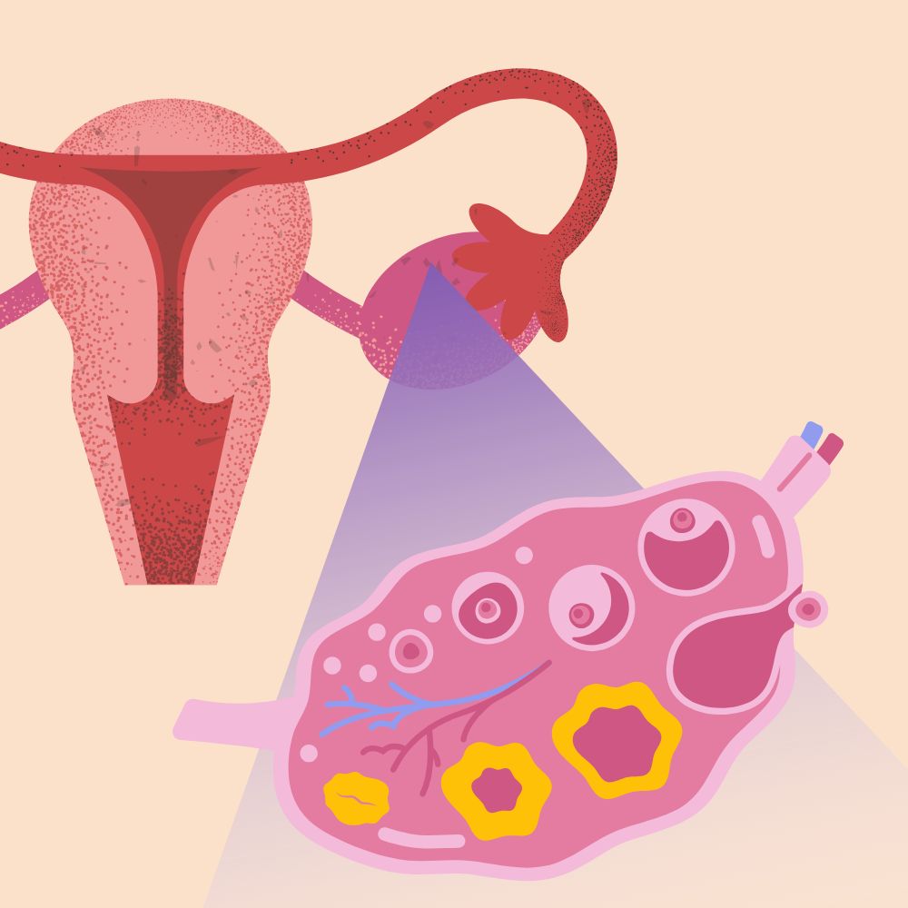 complications du syndrome des ovaires polykystiques