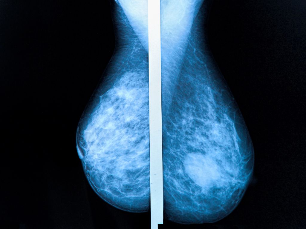 mammographie avec cancer du sein